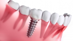 What Are the Risks of Dental Implants Post-Surgery?