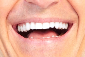 How Long Do Non-Prep Veneers Really Last?