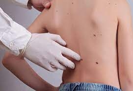 Are Natural Remedies for Skin Tags Safe in Dubai’s Environment