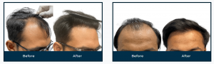 Why Everyone Is Talking About the Best Hair Clinic in Ahmedabad—You Won’t Believe the Results!