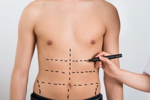 Liposuction for Men Targeting Chest and Abdomen Fat