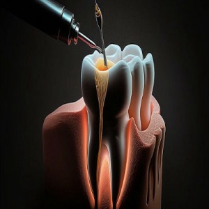 Root Canal Microsurgery in Islamabad: Is It Worth It?