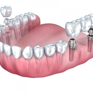 Dental Implants for Seniors: What to Know