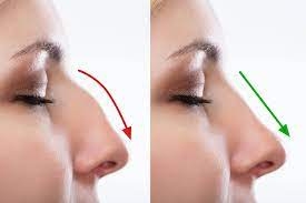 How Do I Manage Pain and Swelling After Rhinoplasty in Dubai