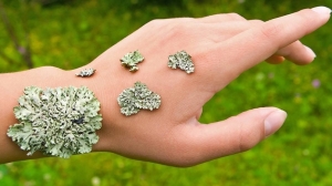 Lichen Planus Market to Surge Owing to Biologic Treatments