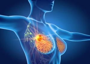 Metastatic Triple-Negative Breast Cancer (mTNBC) Market to Surge by Targeted Immunotherapy Advances