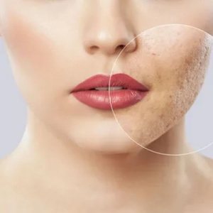 How to Find Experienced Dermatologists for Acne Scars Treatment in Islamabad