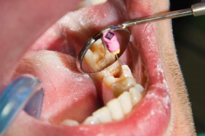 What Makes a Root Canal Fail — and How It’s Fixed