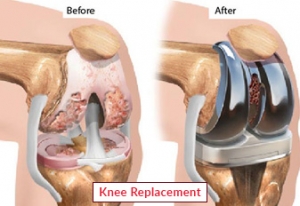 Knee Replacement Surgery in India: Restore Mobility with EdhaCare’s Expert Support