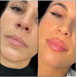 How Fillers Treatments in Dubai Can Enhance Your Natural Beauty
