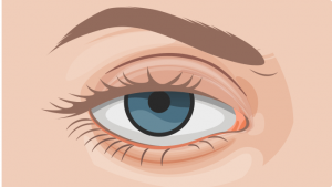 Best Blepharoplasty Surgeon in Sydney: What Sets Them Apart?