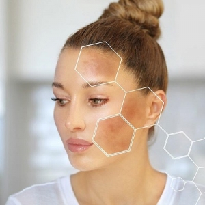 Are Results from Melasma Treatment in Dubai Different for Men and Women