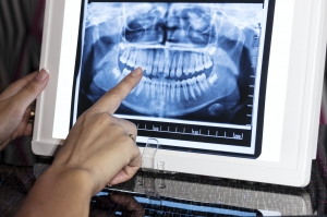 Reading a Panoramic X-Ray: What Dentists Look For