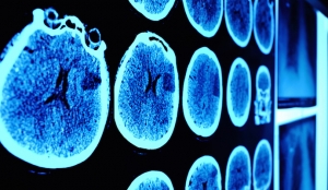 Astrocytoma Drug Market Gains on Personalized Medicine Opportunity