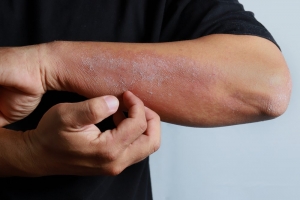 Chronic Plaque Psoriasis Market grows fastest owing to Biologic Therapies