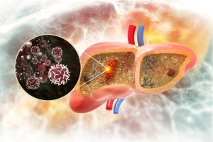 Advanced Liver Cancer Market Will Grow at Highest Pace Owing to Targeted Therapies