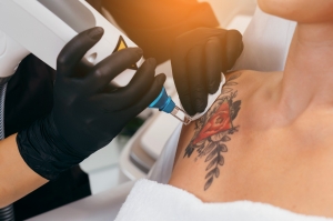 Why People Love Laser Tattoo Removal Treatments