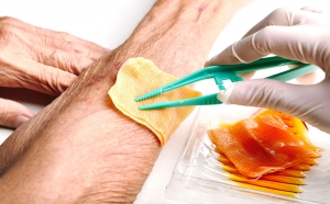 Chronic Wounds Treatment Market Growth Driven by Advanced Biomaterials