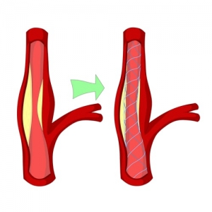 Carotid Artery Stent Market to Expand Rapidly Owing to Rising Cardiovascular Cases