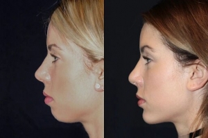 Best Aesthetic Clinic in dubai: Achieve a Defined Chin Fillers