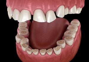 Protect your teeth from grinding damage.