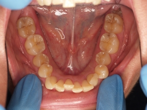 What Are My Options for Fixing Crowded Teeth?