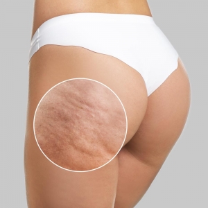 Does massage help cellulite?