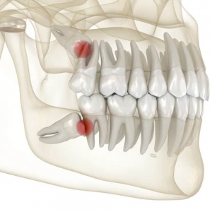 Is it Okay to Play Games After Wisdom Teeth Removal?