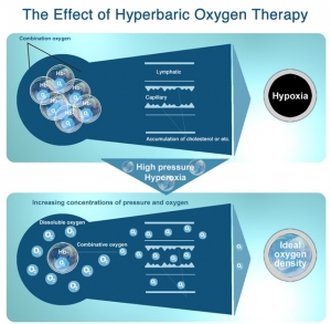 Hyperbaric Oxygen Chamber for Clinical Use