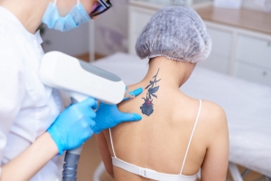 Laser Tattoo Removal in Dubai is Designed for Busy Lives