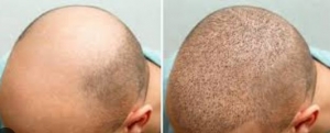 Hair Transplant Turkey: Transformative Before and After Photos