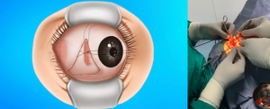 What Is Squint Surgery in Gurgaon and How Can It Improve Vision?
