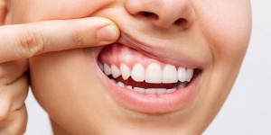 Gum Lightening: What to Expect Before, During, and After