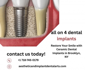The Downsides of All-on-4 Dental Implants You Should Know About