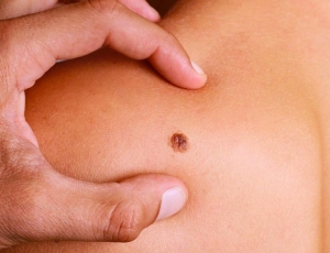 Berwick Skin Cancer Centre