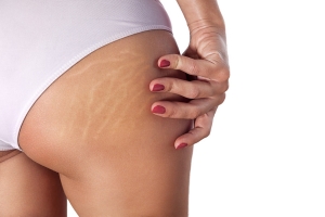 Laser Stretch Marks Treatment That Targets Deep Skin Damage Fast