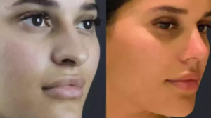 Best Rhinoplasty Surgeon in Dubai for Natural Nose Results