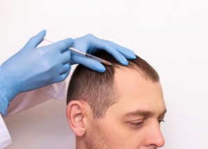 Is Hair Transplant Permanent?