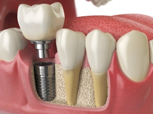 Restore Dental Function with Dental Implants