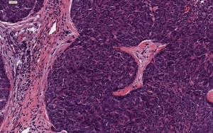 Thymic Carcinoma Drugs Market will grow at pace owing to targeted therapies