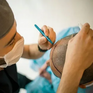 How to Maintain Your Hair Transplant Results in Islamabad