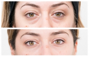 The Male Perspective on Blepharoplasty: Tailoring Surgical Techniques for Masculine Facial Aesthetics