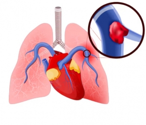 Pulmonary Embolism - New Catheter Based Therapies
