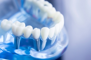 Dental Implants vs. Dentures: Which Option Is Best for You?