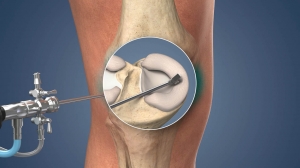 Minimally Invasive Meniscus Surgery: What You Should Know