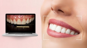 Is Digital Smile Design Worth It? Hear What Patients Say