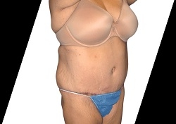 What Can You Expect from a Tummy Tuck Procedure in Houston?