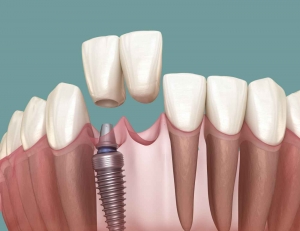 Precision Dental Implants That Fit Perfectly