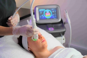 Discover the Fast Results of Fractional RF Microneedling Treatment