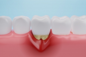 What do healthy gums look like?